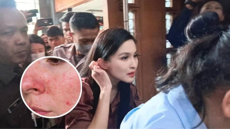 Apa Itu Penyakit Rosacea yang Diidap Sandra Dewi hingga Kulit Wajahnya Bernanah? 