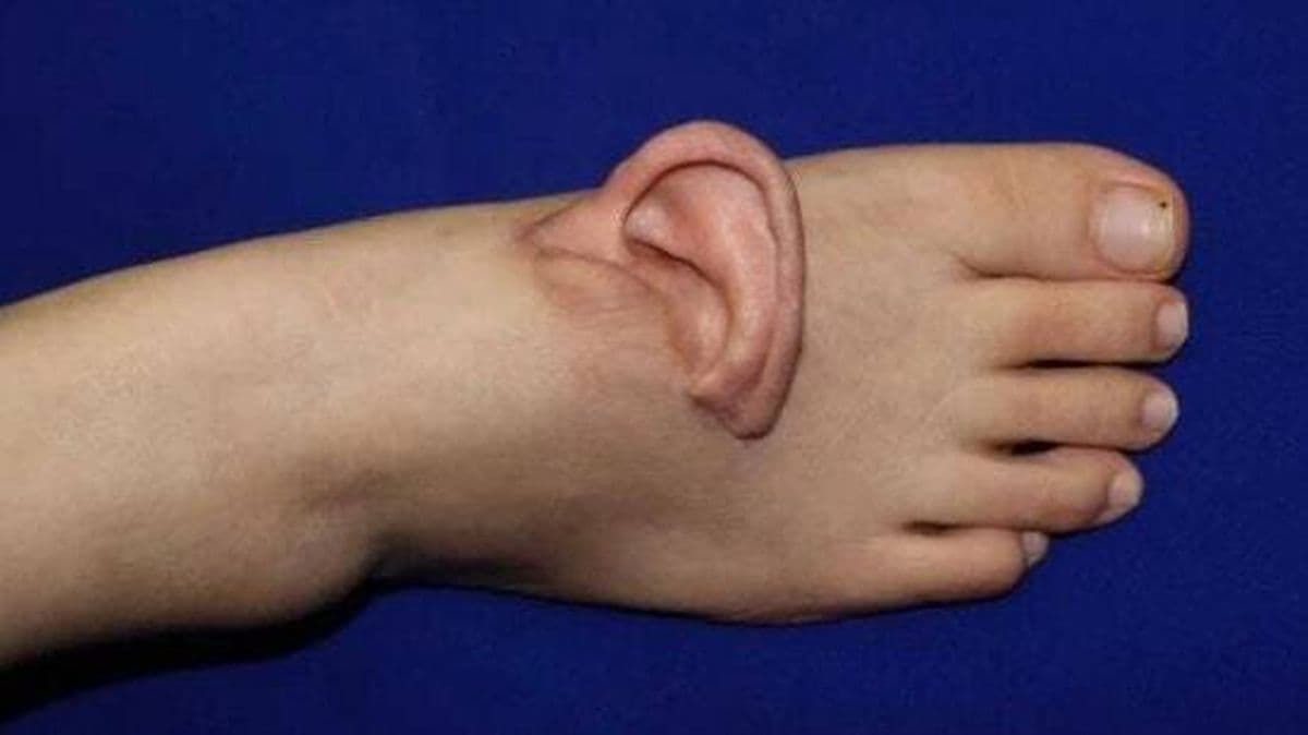 Telinga Wanita Ini di Ada Kaki Pascaoperasi Kecelakaan Kerja