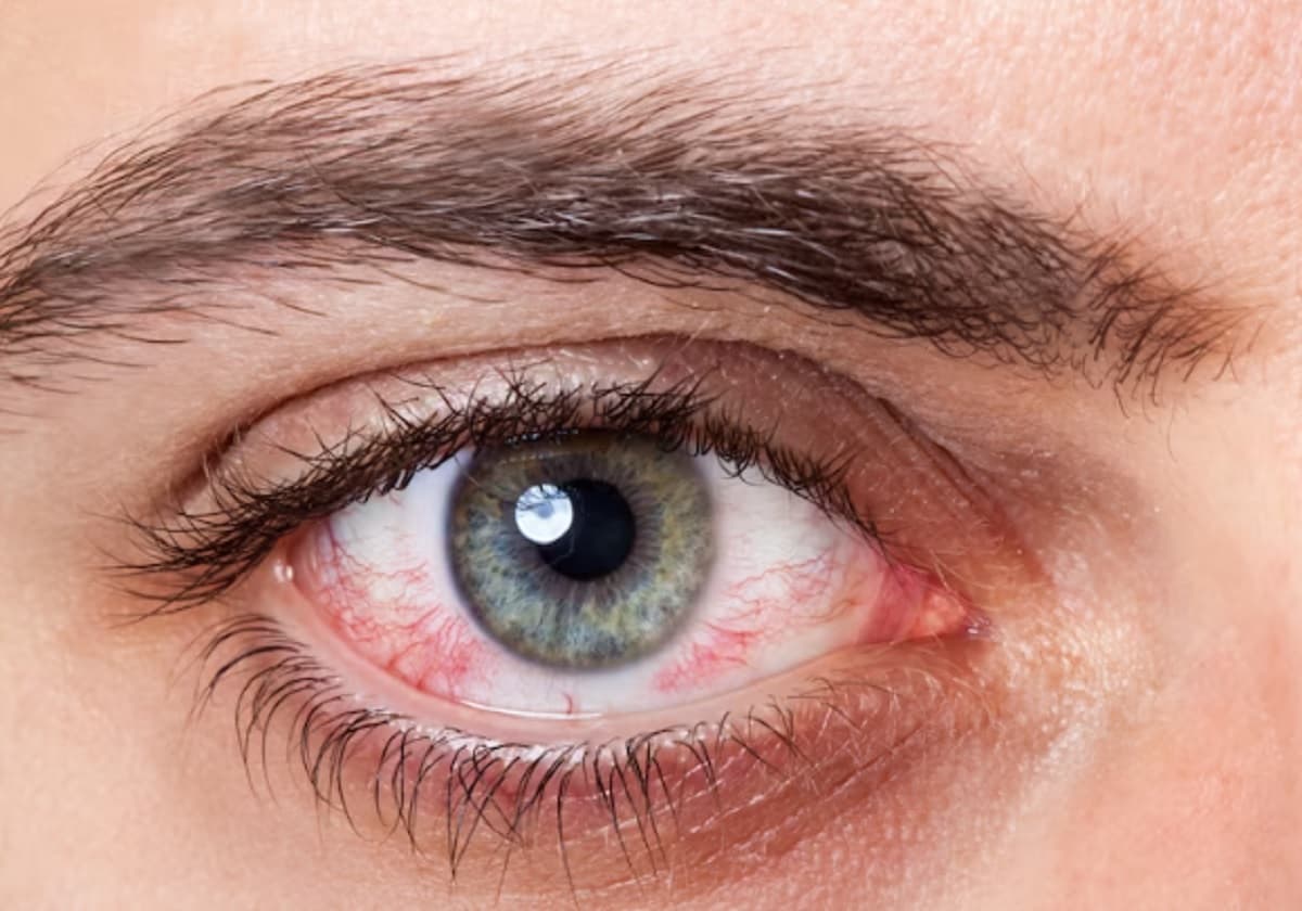 Sindrom Mata Kering, Kenali Gejala dan Pengobatannya