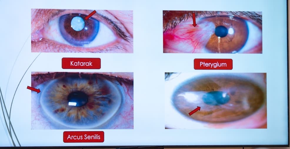 Mengenal Glaukoma: Gejala, Faktor Risiko, hingga Jenis-jenisnya