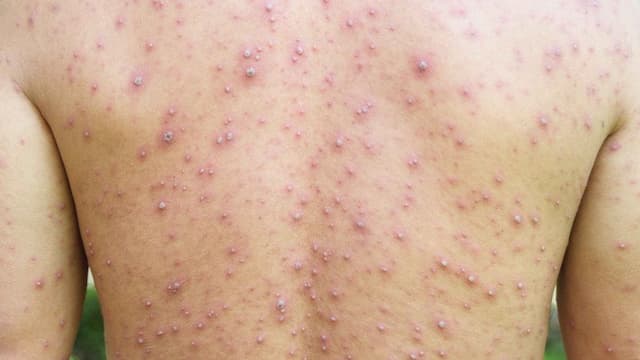 Apakah Orang Dewasa Bisa Terkena Campak 2 Kali?