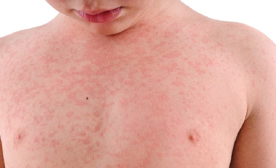 Ciri-Ciri Anak Terkena Penyakit Campak