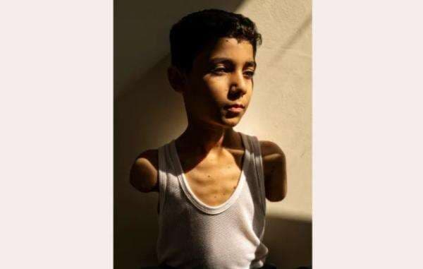 Foto Bocah Gaza Kehilangan 2 Tangan Menangkan Penghargaan World Press Photo 2025 Foto Bocah Gaza Kehilangan 2 Tangan Menangkan Penghargaan World Press Photo 2025