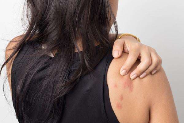 Awas Gatal! Ini 5 Tips Mengatasi Biduran di Musim Hujan Awas Gatal! Ini 5 Tips Mengatasi Biduran di Musim Hujan