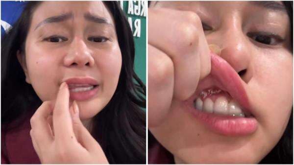 Denise Chariesta Alami Kista di Gigi, Gejalanya Sering Sakit Kepala dan Emosian! Denise Chariesta Alami Kista di Gigi, Gejalanya Sering Sakit Kepala dan Emosian!