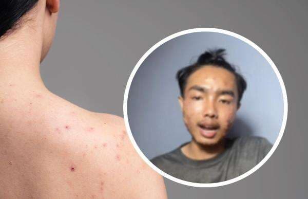 Heboh gegara Baju Thrifting Pria Ini Kena Penyakit Kulit Mengerikan, Ini Faktanya! Heboh gegara Baju Thrifting Pria Ini Kena Penyakit Kulit Mengerikan, Ini Faktanya!