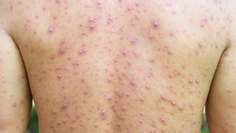 Izin Vaksin Campak untuk Dewasa Keluar, Kemenkes Prioritaskan Vaksinasi bagi Tenaga Kesehatan Izin Vaksin Campak untuk Dewasa Keluar, Kemenkes Prioritaskan Vaksinasi bagi Tenaga Kesehatan