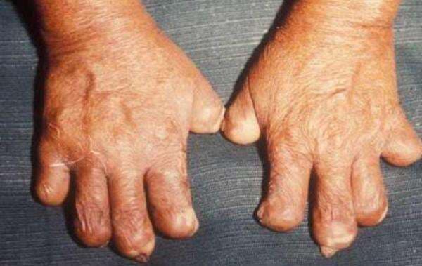 Viral! 2 WNI Terkonfirmasi Mengidap Penyakit Kusta di Rumania, Kasus Pertama Setelah 40 Tahun Viral! 2 WNI Terkonfirmasi Mengidap Penyakit Kusta di Rumania, Kasus Pertama Setelah 40 Tahun